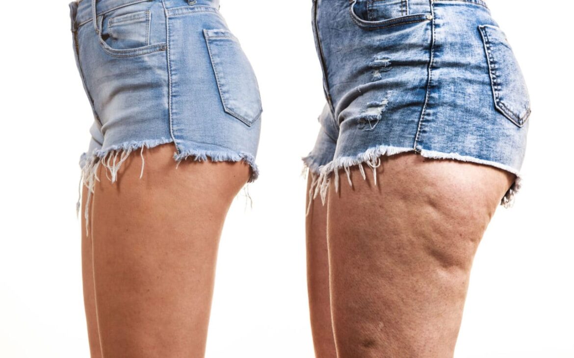 No todo hoyuelo es celulitis (y no toda pierna grande es lipedema)